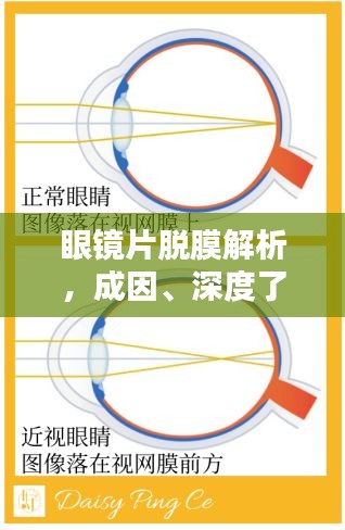 眼镜片脱膜解析，成因、深度了解及应对之道