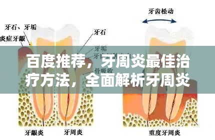 百度推荐，牙周炎最佳治疗方法，全面解析牙周炎治愈之道！